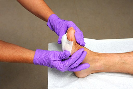 Early Care for Serious Complications of Diabetic Foot Ulcers