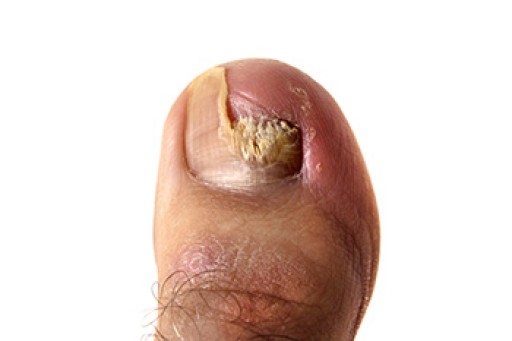 Treating Toenail Fungus