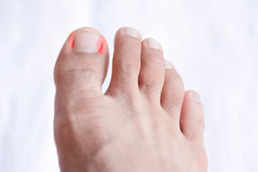 What Causes an Ingrown Toenail?