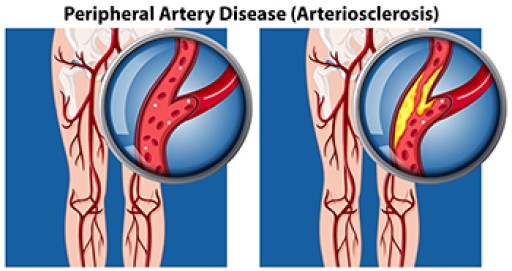 Peripheral Artery Disease