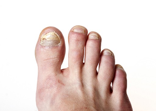 Treating Toenail Fungus