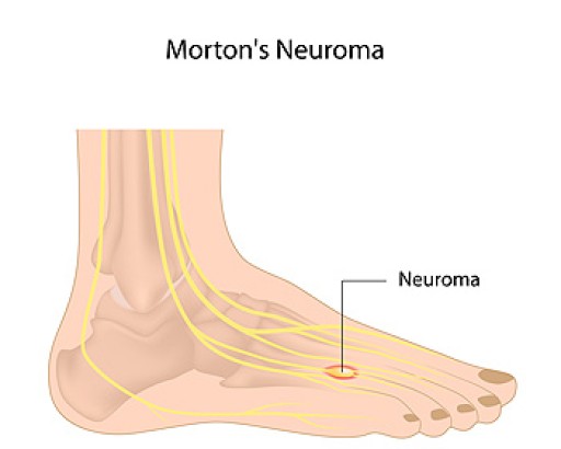 Morton's Neuroma