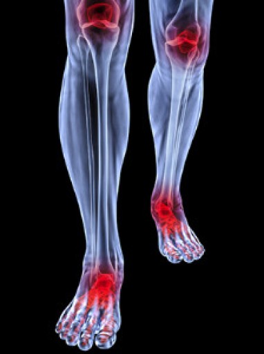 Arthritic Foot Care