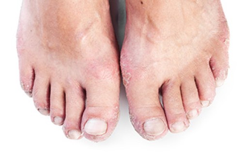 Arthritic Foot Care