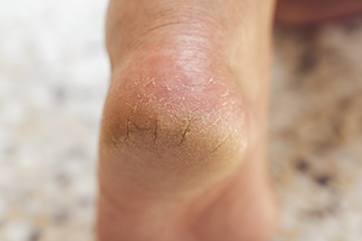 Definition and Risk Factors for Cracked Heels