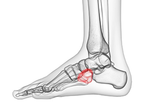 An Ankle Injury May Cause Cuboid Syndrome