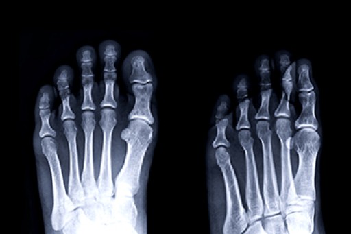 Causes, Symptoms, and Treatment for a Broken Foot